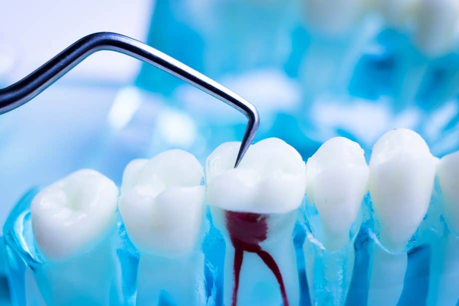 Endodontic Surgery vs. Root Canal Therapy: What's the Difference?